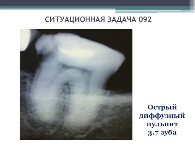 СИТУАЦИОННАЯ ЗАДАЧА 092 Острый диффузный пульпит 3.7 зуба