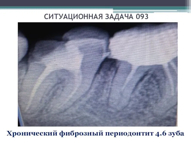 СИТУАЦИОННАЯ ЗАДАЧА 093 Хронический фиброзный периодонтит 4.6 зуба