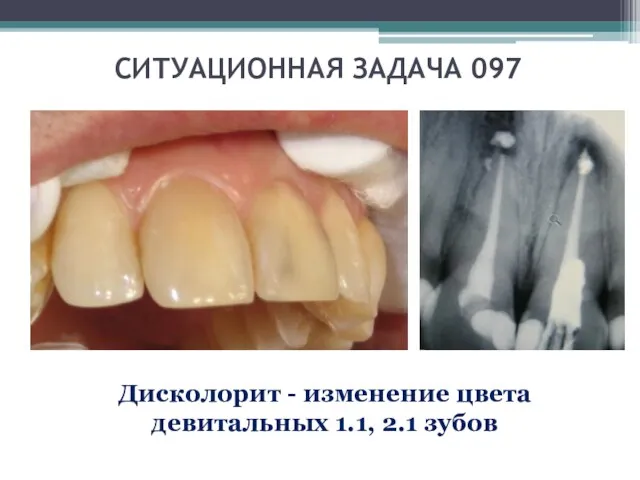 СИТУАЦИОННАЯ ЗАДАЧА 097 Дисколорит - изменение цвета девитальных 1.1, 2.1 зубов