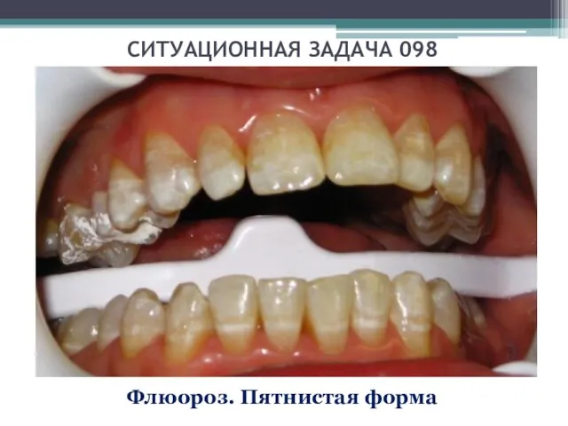 СИТУАЦИОННАЯ ЗАДАЧА 098 Флюороз. Пятнистая форма