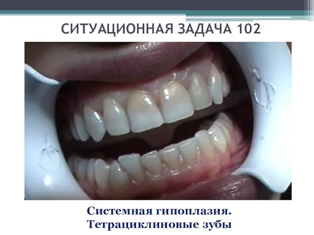 СИТУАЦИОННАЯ ЗАДАЧА 102 Системная гипоплазия. Тетрациклиновые зубы