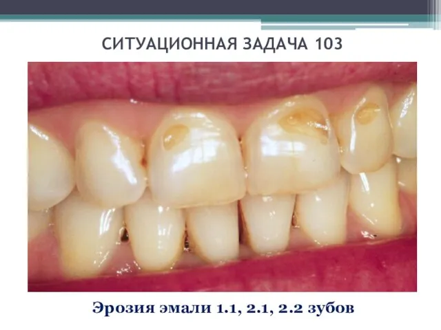 СИТУАЦИОННАЯ ЗАДАЧА 103 Эрозия эмали 1.1, 2.1, 2.2 зубов