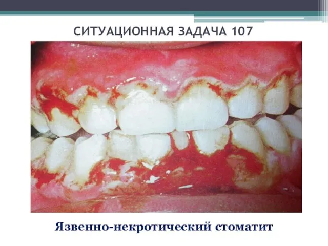 СИТУАЦИОННАЯ ЗАДАЧА 107 Язвенно-некротический стоматит