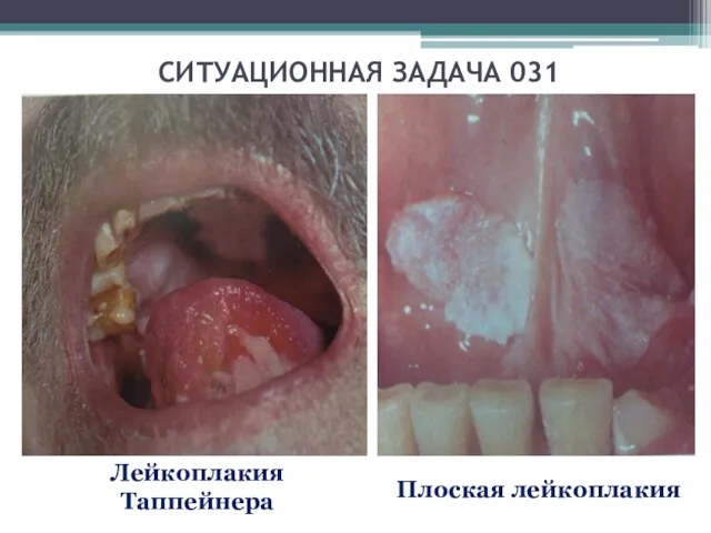 СИТУАЦИОННАЯ ЗАДАЧА 031 Лейкоплакия Таппейнера Плоская лейкоплакия