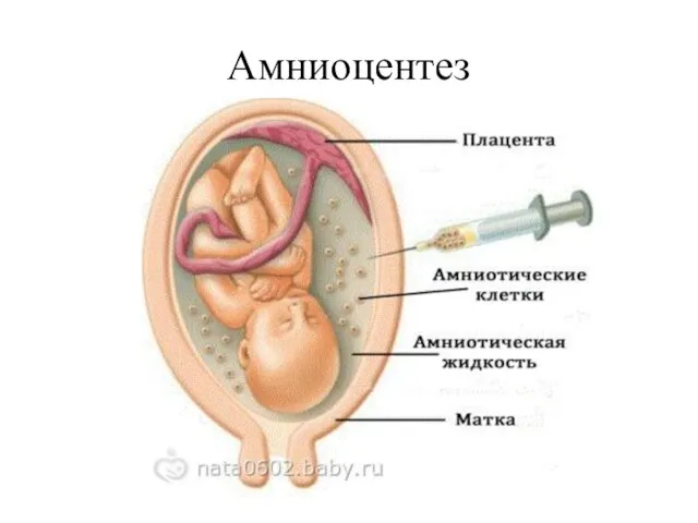 Амниоцентез