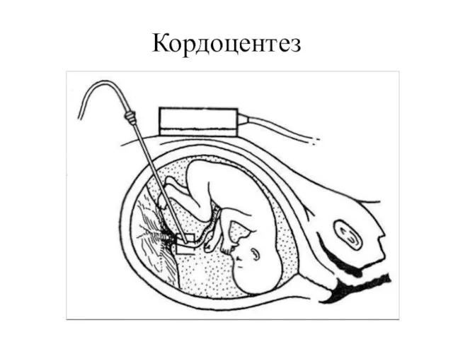 Кордоцентез