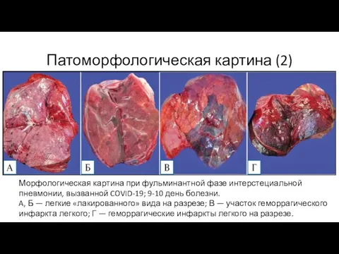 Патоморфологическая картина (2) Морфологическая картина при фульминантной фазе интерстециальной пневмонии, вызванной COVID-19; 9-10