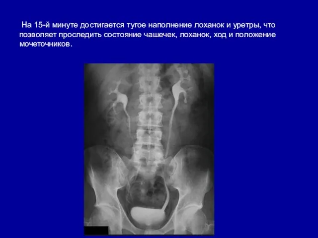 На 15-й минуте достигается тугое наполнение лоханок и уретры, что