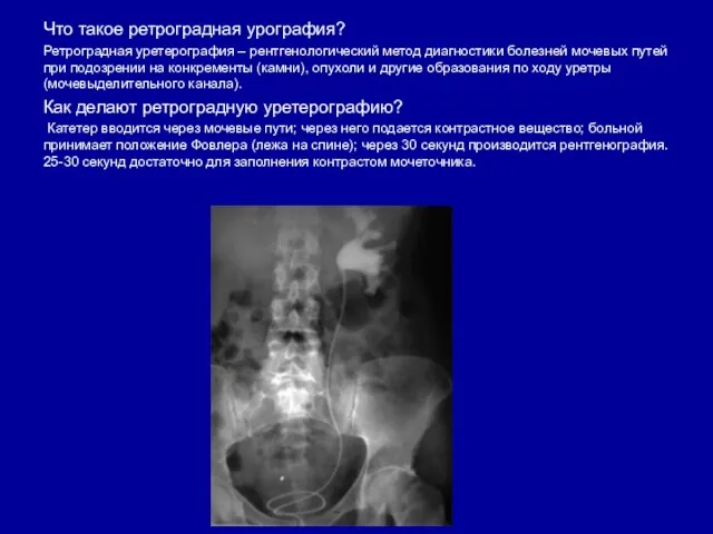 Что такое ретроградная урография? Ретроградная уретерография – рентгенологический метод диагностики