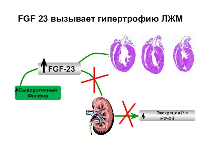 FGF 23 вызывает гипертрофию ЛЖМ Сывороточный Фосфор FGF-23 Экскреция P с мочой