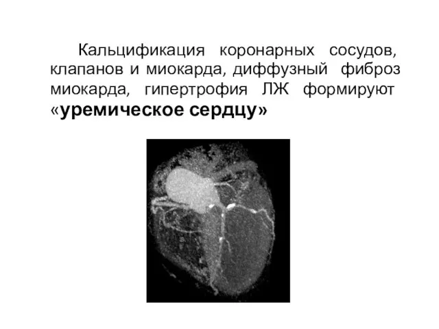 Кальцификация коронарных сосудов, клапанов и миокарда, диффузный фиброз миокарда, гипертрофия ЛЖ формируют «уремическое сердцу»
