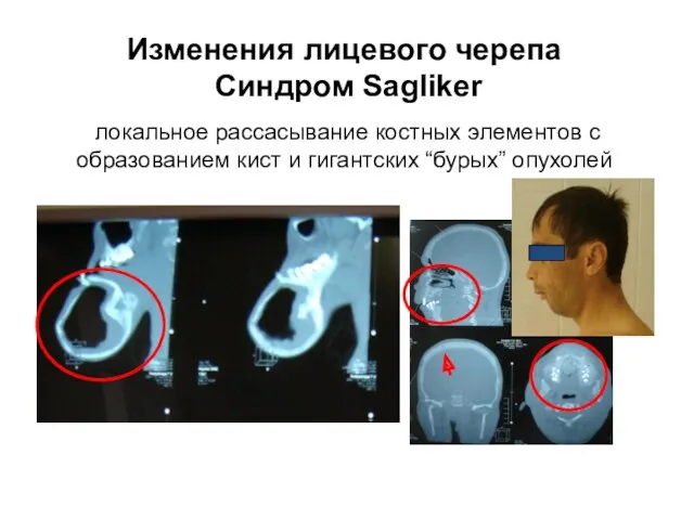 Изменения лицевого черепа Синдром Sagliker локальное рассасывание костных элементов с