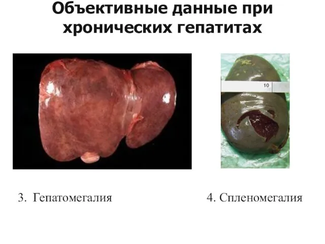 Гепатомегалия 4. Спленомегалия Объективные данные при хронических гепатитах