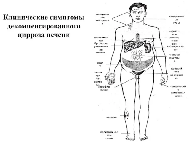 Клинические симптомы декомпенсированного цирроза печени «сосудистые звездочки» лакированные губы гинекомастия