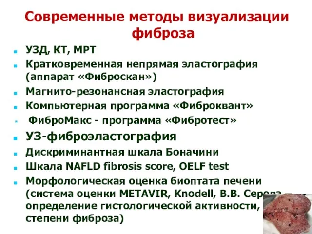 Современные методы визуализации фиброза УЗД, КТ, МРТ Кратковременная непрямая эластография