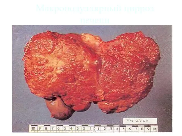 Макронодуллярный цирроз печени