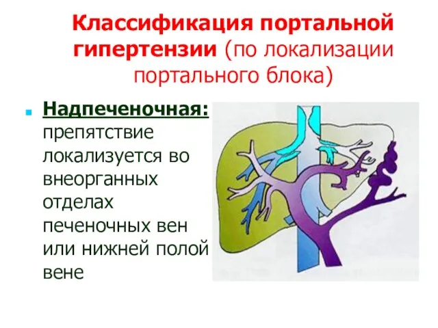 Классификация портальной гипертензии (по локализации портального блока) Надпеченочная: препятствие локализуется