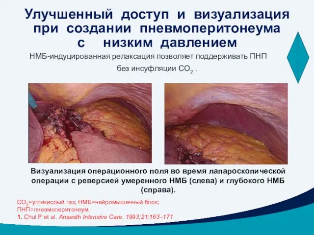 Улучшенный доступ и визуализация при создании пневмоперитонеума с низким давлением