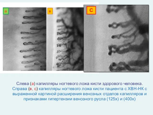 Слева (а) капилляры ногтевого ложа кисти здорового человека. Справа (в,