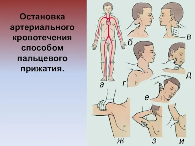 Остановка артериального кровотечения способом пальцевого прижатия.