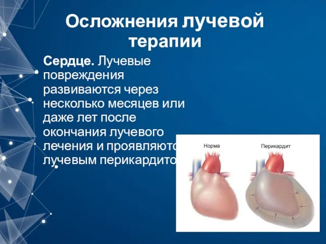 Осложнения лучевой терапии Сердце. Лучевые повреждения развиваются через несколько месяцев или даже лет