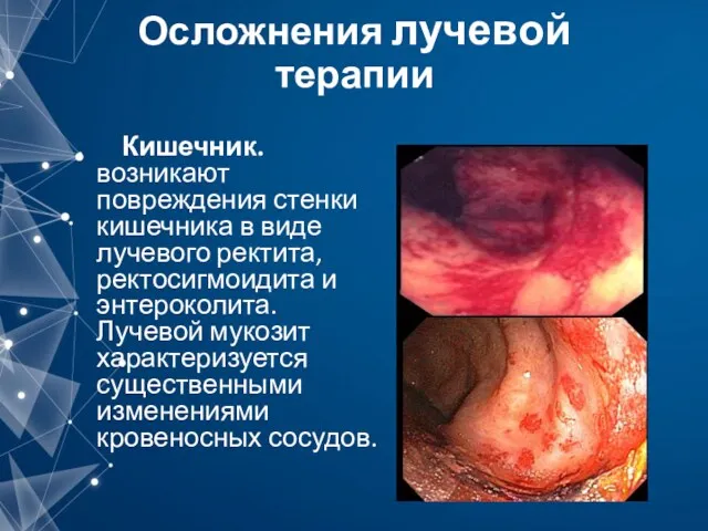 Осложнения лучевой терапии Кишечник. возникают повреждения стенки кишечника в виде лучевого ректита, ректосигмоидита