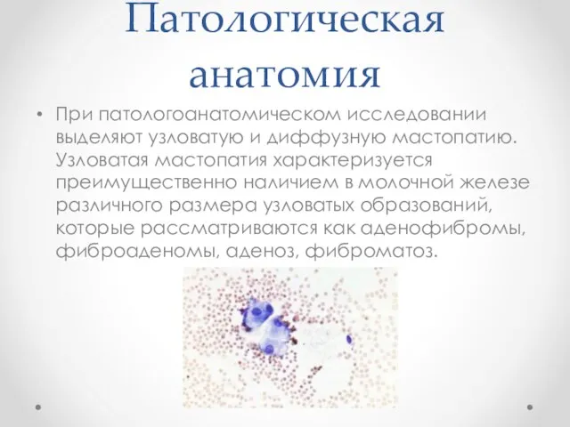 Патологическая анатомия При патологоанатомическом исследовании выделяют узловатую и диффузную мастопатию. Узловатая мастопатия характеризуется