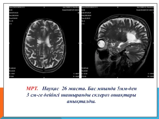 МРТ. Науқас 26 жаста. Бас миында 5мм-ден 3 см-ге дейінгі шашыранды склероз ошақтары анықталды.