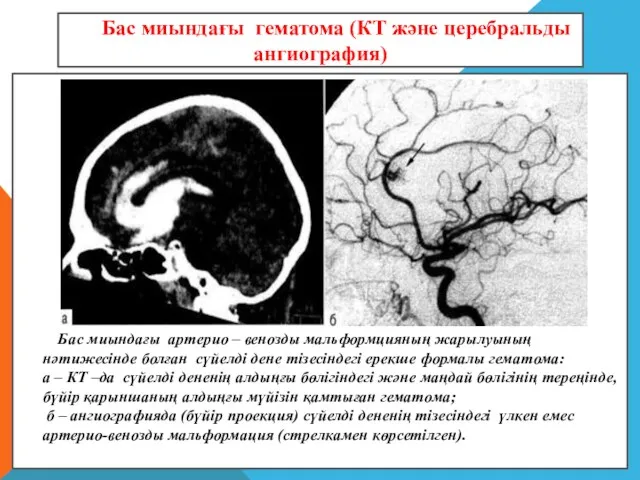 Бас миындағы артерио – венозды мальформцияның жарылуының нәтижесінде болған сүйелді