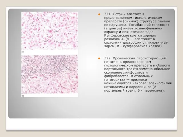 321. Острый гепатит: в представленном гистологическом препарате (снимок) структура печени