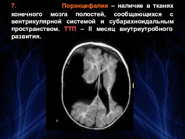 7. Порэнцефалия – наличие в тканях конечного мозга полостей, сообщающихся с вентрикулярной системой