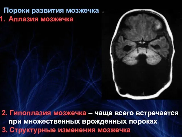 Пороки развития мозжечка Аплазия мозжечка 2. Гипоплазия мозжечка – чаще всего встречается при