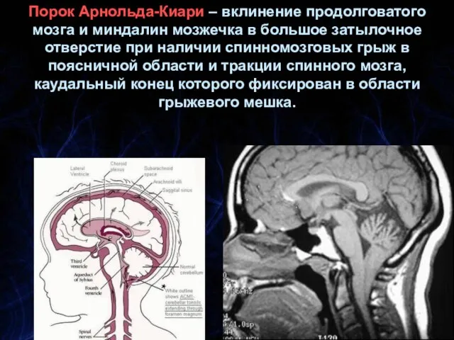 Порок Арнольда-Киари – вклинение продолговатого мозга и миндалин мозжечка в большое затылочное отверстие