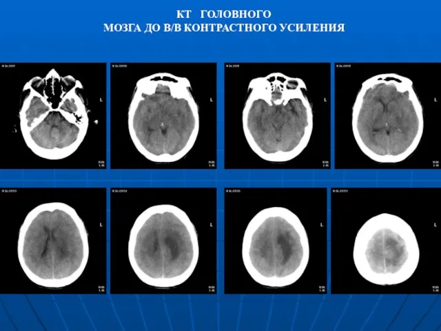 КТ ГОЛОВНОГО МОЗГА ДО В/В КОНТРАСТНОГО УСИЛЕНИЯ