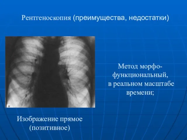 Рентгеноскопия (преимущества, недостатки) Метод морфо-функциональный, в реальном масштабе времени; Изображение прямое (позитивное)