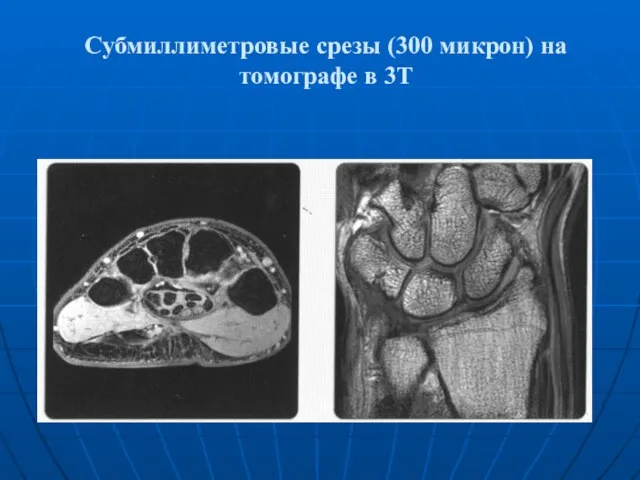 Субмиллиметровые срезы (300 микрон) на томографе в 3Т