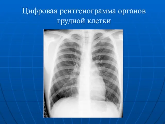 Цифровая рентгенограмма органов грудной клетки