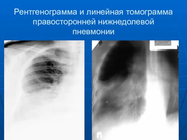 Рентгенограмма и линейная томограмма правосторонней нижнедолевой пневмонии