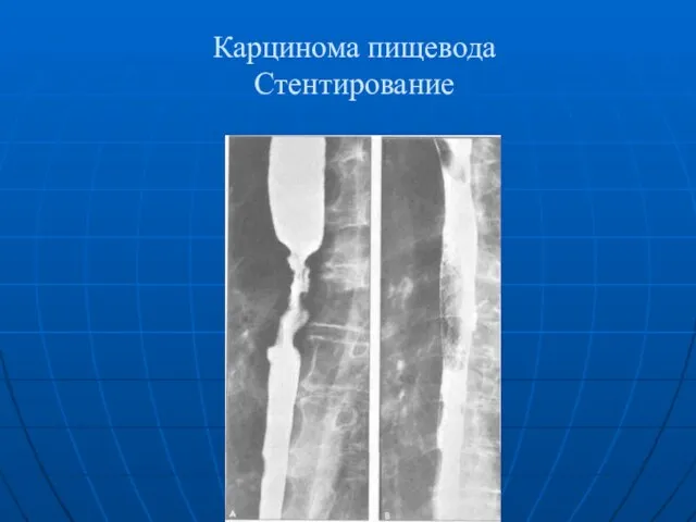 Карцинома пищевода Стентирование