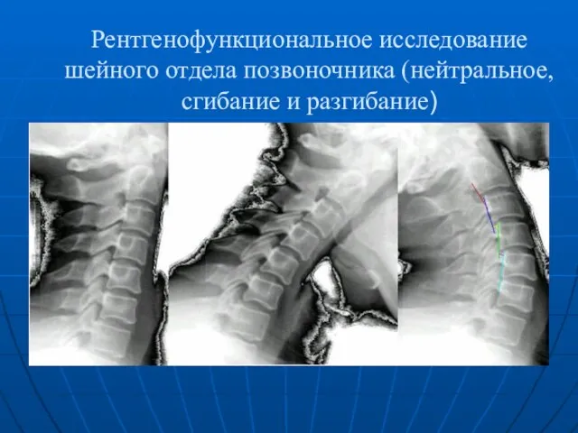 Рентгенофункциональное исследование шейного отдела позвоночника (нейтральное, сгибание и разгибание)