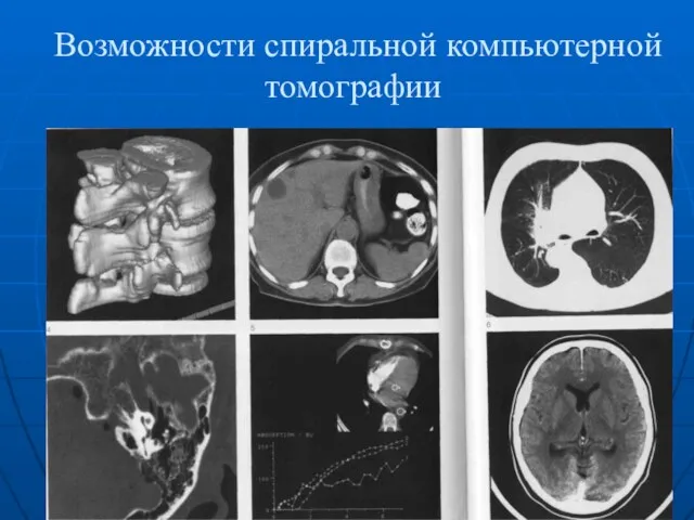 Возможности спиральной компьютерной томографии