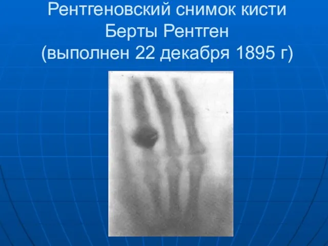 Рентгеновский снимок кисти Берты Рентген (выполнен 22 декабря 1895 г)