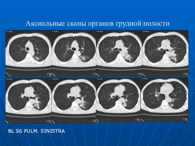 Аксиальные сканы органов грудной полости BL S6 PULM. SINISTRA