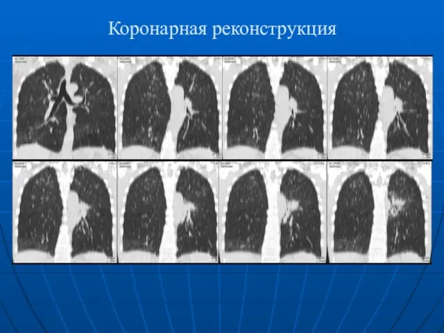 Коронарная реконструкция