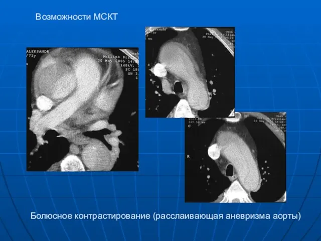 Возможности МСКТ Болюсное контрастирование (расслаивающая аневризма аорты)