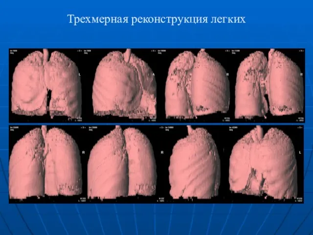 Трехмерная реконструкция легких