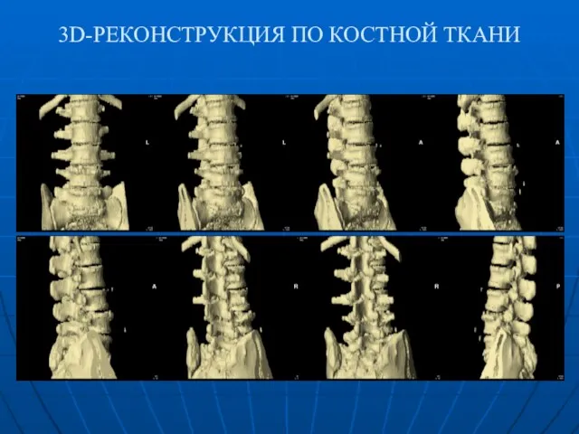 3D-РЕКОНСТРУКЦИЯ ПО КОСТНОЙ ТКАНИ