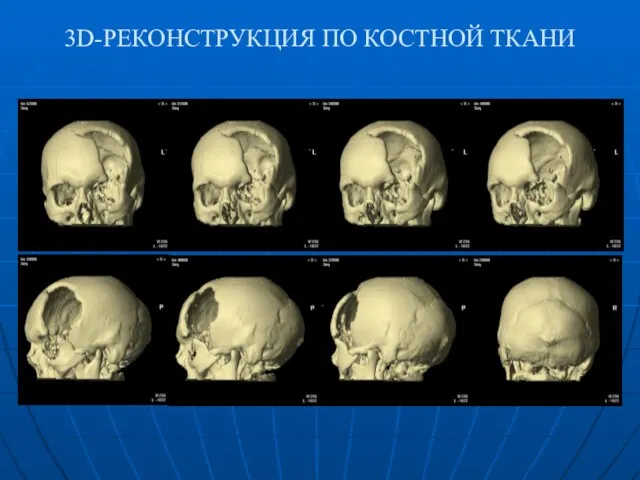 3D-РЕКОНСТРУКЦИЯ ПО КОСТНОЙ ТКАНИ