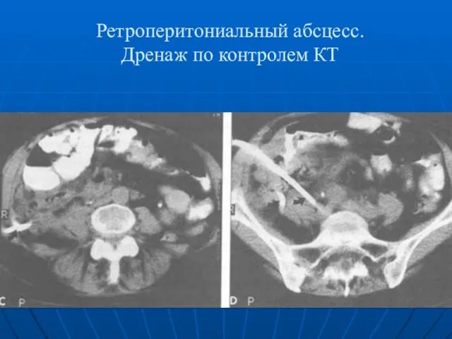 Ретроперитониальный абсцесс. Дренаж по контролем КТ