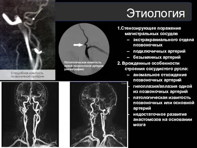 Этиология 1.Стенозирующее поражение магистральных сосудов экстракраниального отдела позвоночных подключичных артерий безымянных артерий 2.